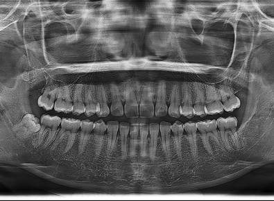 파노라마 X-ray